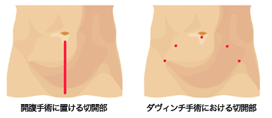 開腹手術における切開部 ダヴィンチ手術における切開部